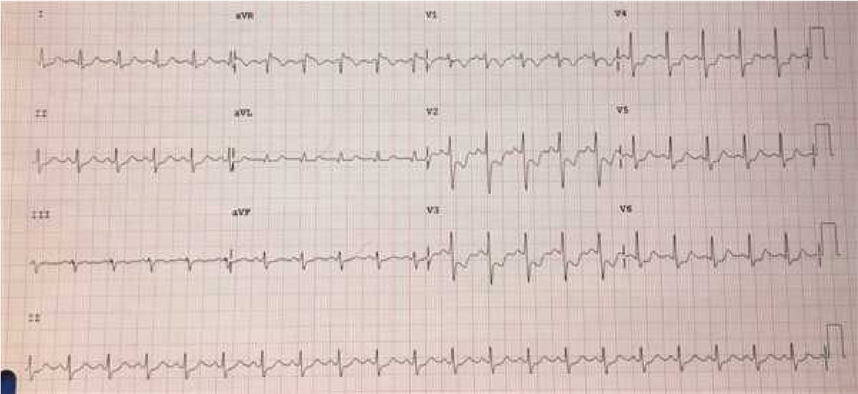 ECG de la pregunta 7 del examen MIR 2017 (convocatoria 2016): frecuencia por encima de 100 lpm con discreto descenso del ST en varias derivaciones, isquemia por aumento de la demanda de oxígeno