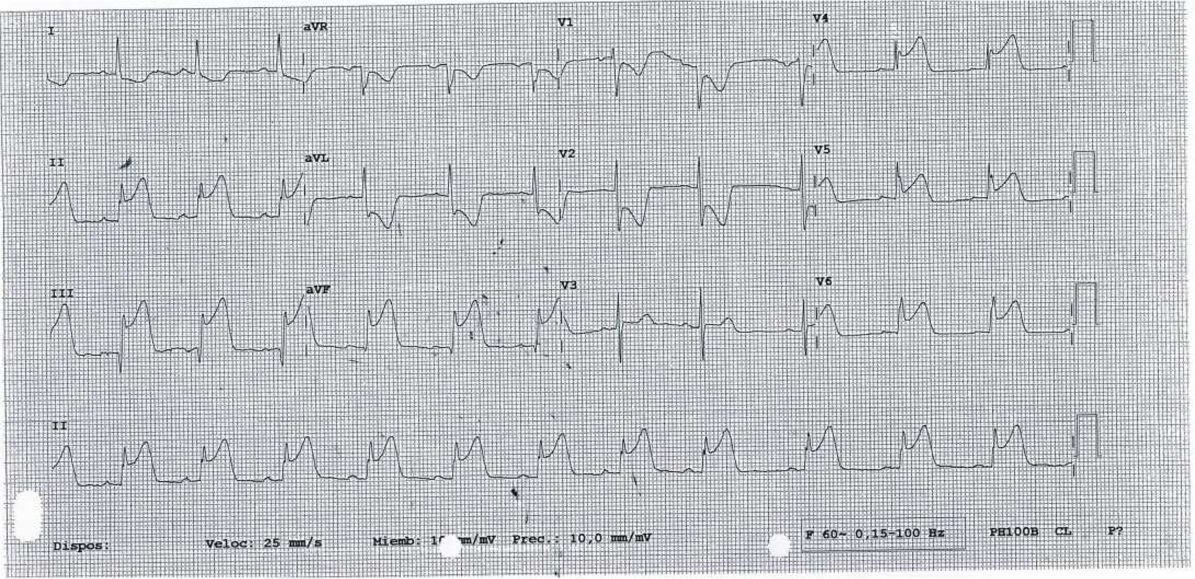 ECG de la pregunta 9 del examen MIR 2017 (convocatoria 2016): elevación del ST en DII, DIII y aVF con descenso del ST en V1 y V2, infarto inferolateral agudo