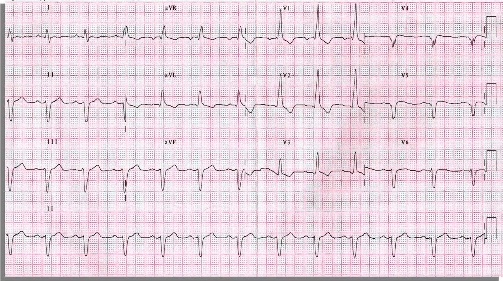 ECG de la pregunta 1 del examen MIR 2018 (convocatoria 2017): QRS ancho y positivo en V1 con eje izquierdo, bloqueo de rama derecha con hemibloqueo anterior