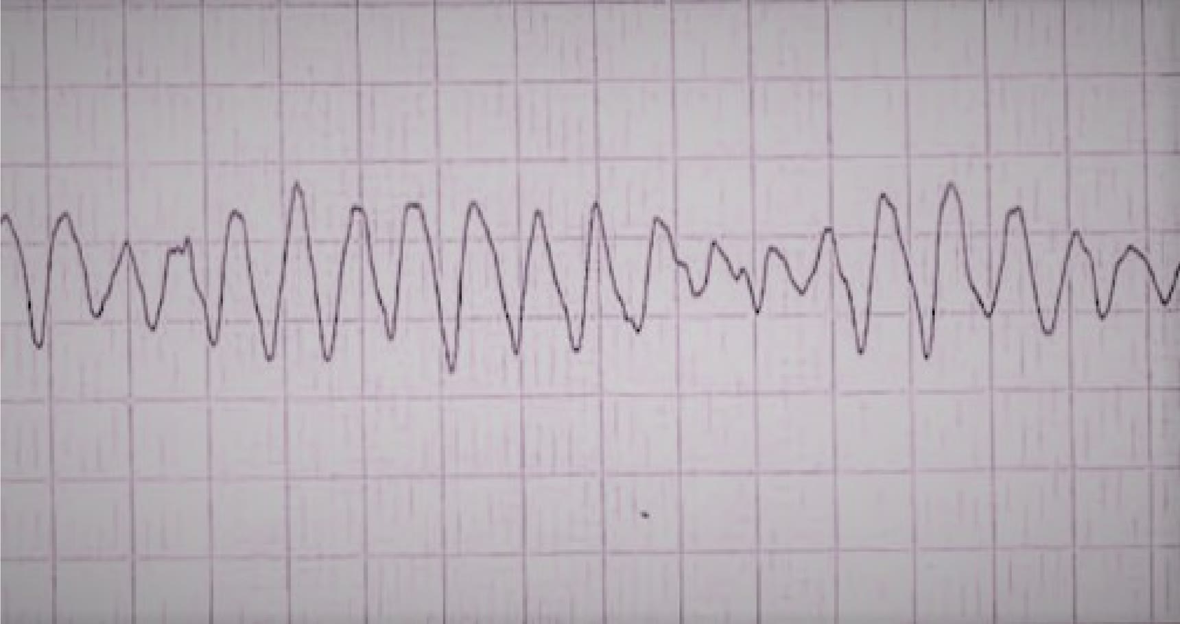 Tira de monitor de la pregunta 30 del examen MIR 2018 (convocatoria 2017): ondas anchas, rapidísimas y de amplitud cambiante, fibrilación ventricular