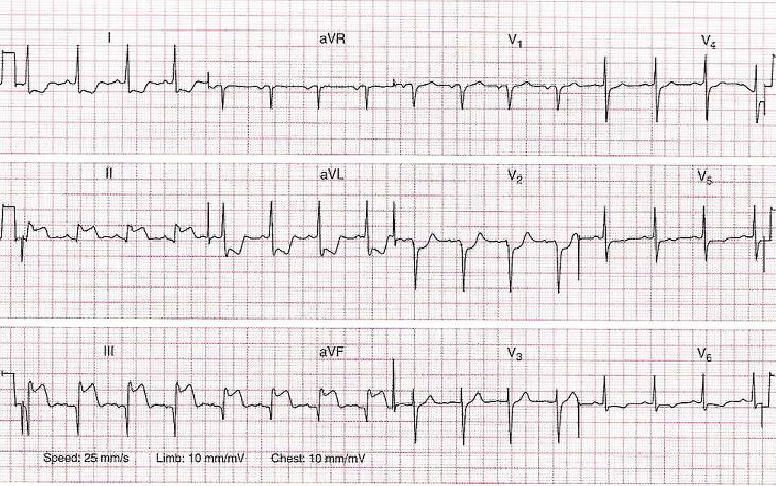 ECG de la pregunta 7 del examen MIR 2019 (convocatoria 2018): ritmo sinusal con elevación del ST en DII, DIII y aVF, en un paciente con dolor torácico que toma sildenafilo