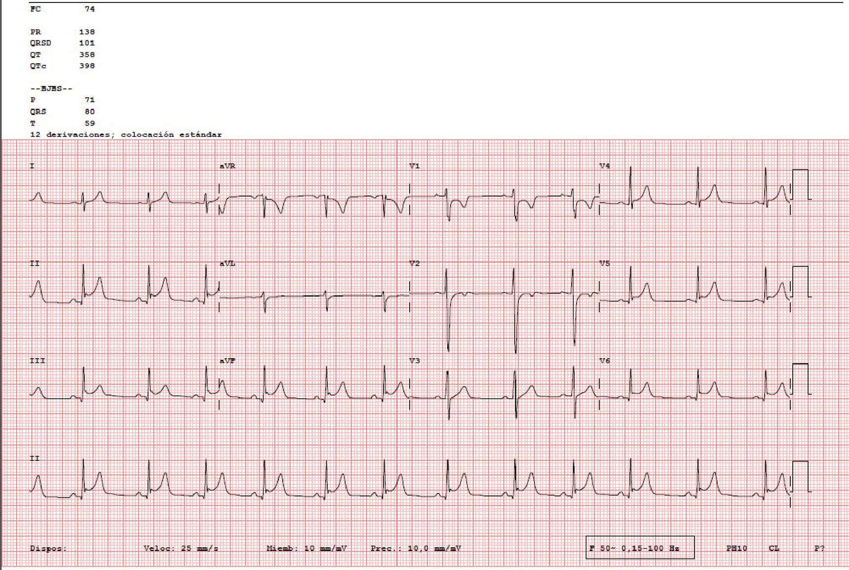 ECG de la pregunta 23 del examen MIR 2021 (convocatoria 2020): ritmo sinusal con elevación cóncava del ST en casi todas las derivaciones y descenso del ST en aVR, en una paciente con pericarditis aguda
