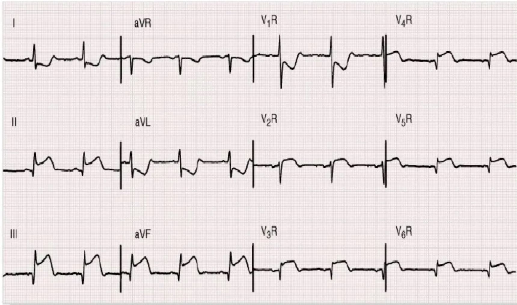 ECG de la pregunta 22 del examen MIR 2022 (convocatoria 2021): elevación del ST en DII, DIII y aVF y en las precordiales derechas, de V2R a V6R: infarto inferior con afectación del ventrículo derecho