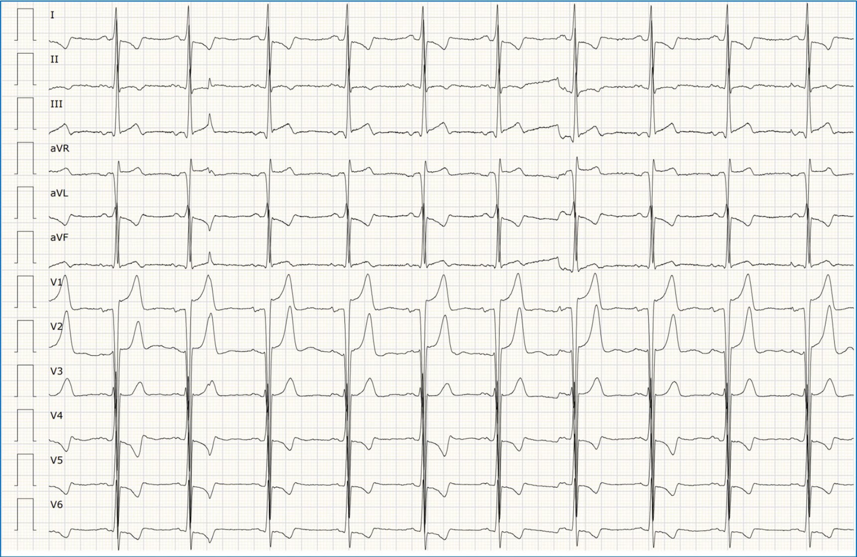 ECG de la pregunta 23 del examen MIR 2022 (convocatoria 2021): ritmo sinusal con QRS de voltaje aumentado que se superponen en las precordiales y ondas T negativas asimétricas en derivaciones izquierdas, en un joven con miocardiopatía