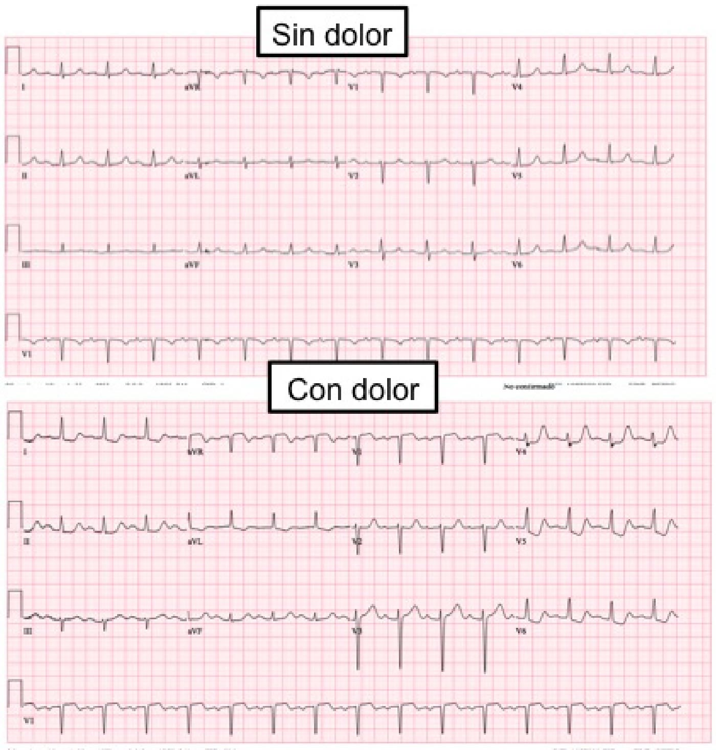 ECG de la pregunta 4 del examen MIR 2023 (convocatoria 2022): dos trazados de la misma paciente, sin dolor y con dolor; con dolor, taquicardia sinusal con descenso del ST de V4 a V6