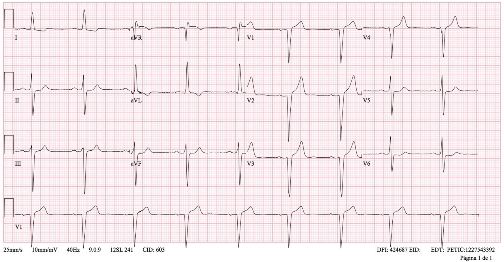 ECG de la pregunta 5 del examen MIR 2023 (convocatoria 2022): ritmo sinusal con eje izquierdo y onda R alta en aVL, en un paciente con miocardiopatía hipertrófica