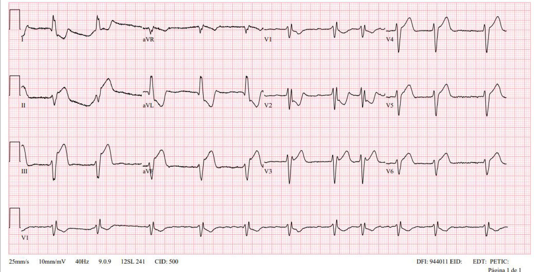 ECG de la pregunta 13 del examen MIR 2024 (convocatoria 2023): fibrilación auricular con ritmo irregular, bloqueo de rama derecha con hemibloqueo anterior izquierdo y elevación del ST en derivaciones inferiores