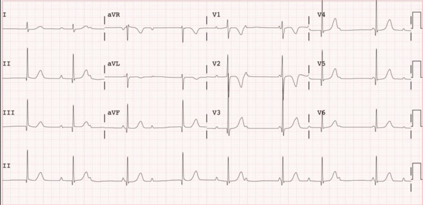 ECG de la pregunta 12 del examen MIR 2025 (convocatoria 2024): ondas P sinusales con intervalos PR variables (unos muy cortos y otros muy largos) y más ondas P que QRS; bloqueo AV de tercer grado