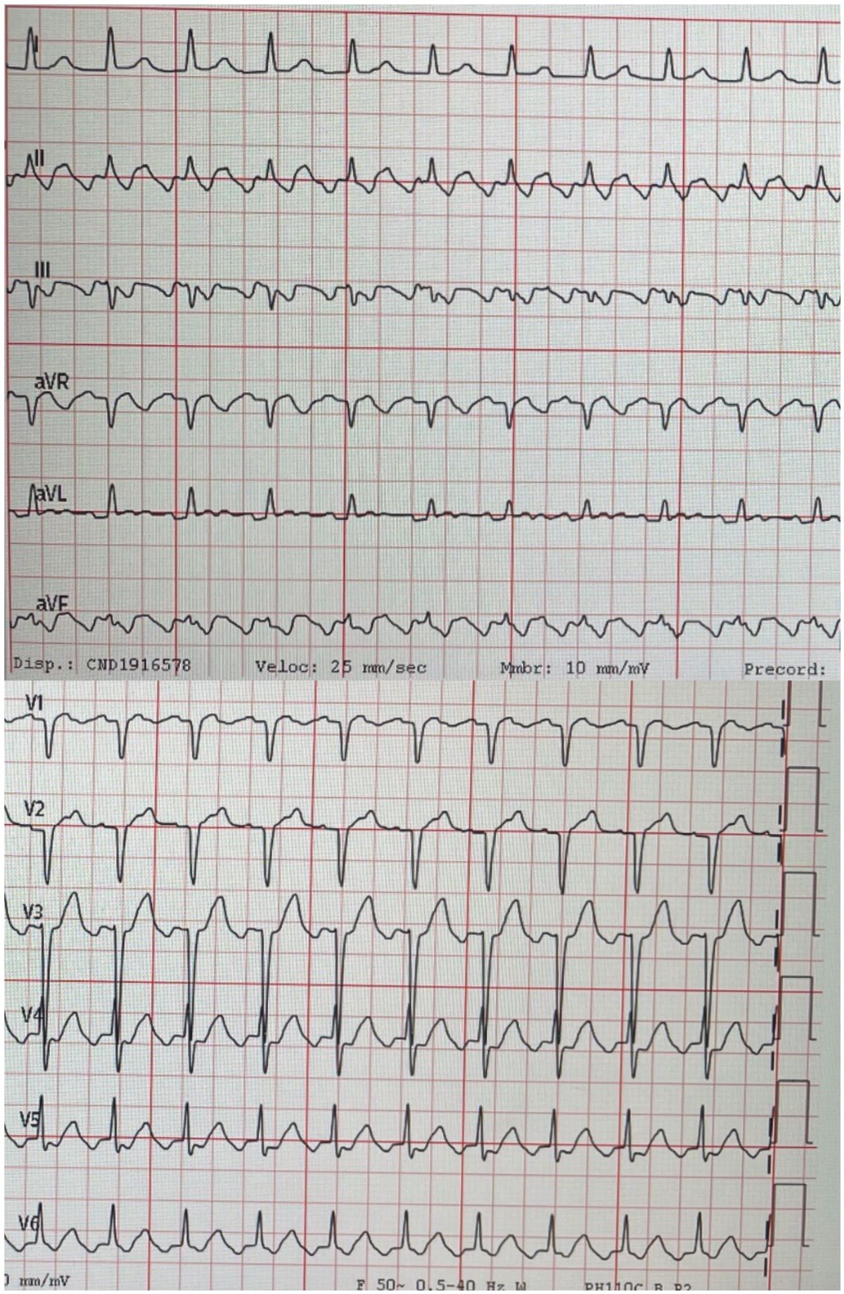 ECG de la pregunta 13 del examen MIR 2025 (convocatoria 2024): taquicardia regular de QRS estrecho con ondas de sierra en la cara inferior, flutter auricular