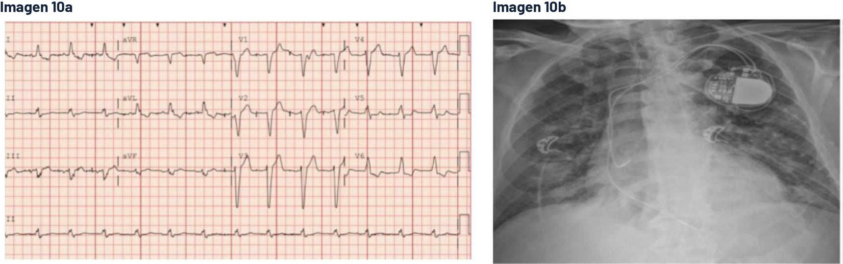 ECG y radiografía de tórax de la pregunta 10 del examen MIR 2026 (convocatoria 2025): paciente con marcapasos e insuficiencia cardiaca aguda