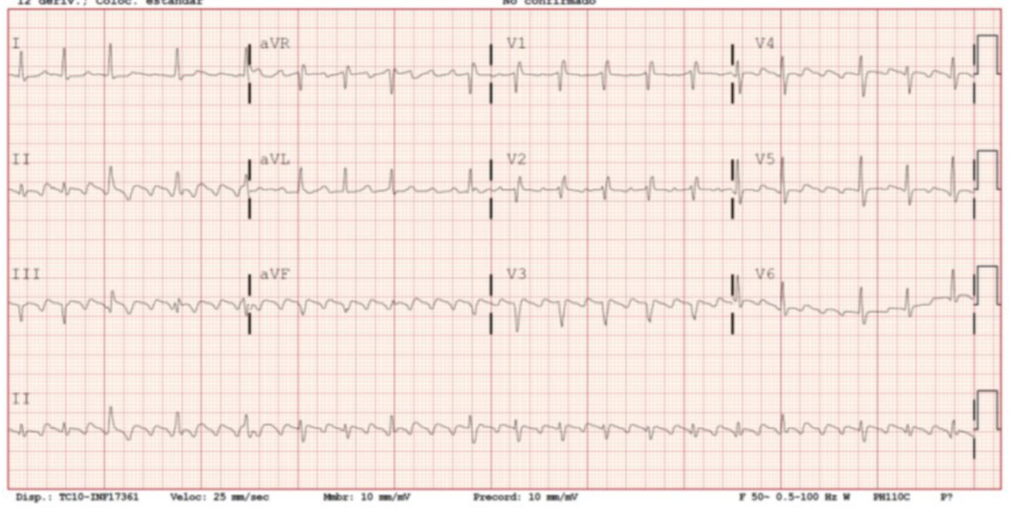 ECG de la pregunta 11 del examen MIR 2026 (convocatoria 2025): ondas de sierra con conducción auriculoventricular variable, flutter auricular común