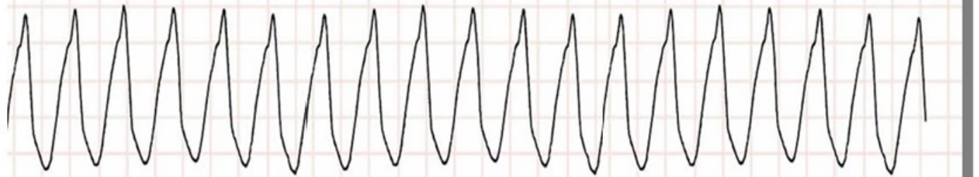 Tira de monitor de la pregunta 25 del examen MIR 2026 (convocatoria 2025): taquicardia regular de QRS ancho en un paciente en parada, ritmo desfibrilable