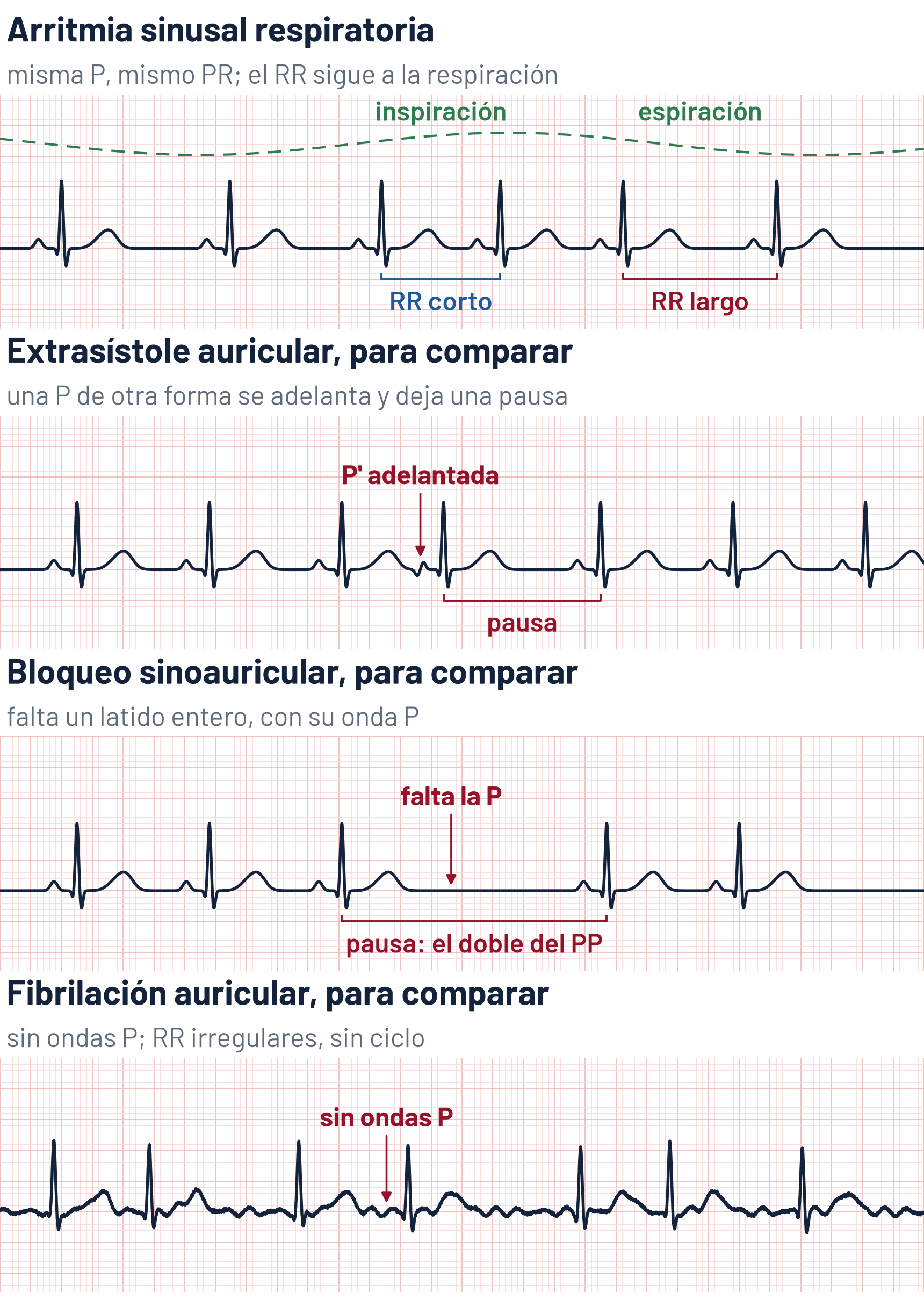 Esquema de cuatro tiras de ECG a 25 mm/s. Arritmia sinusal respiratoria: con la curva de la respiración encima, la misma onda P y el mismo PR en todos los latidos; el RR se acorta al final de la inspiración (771 ms) y se alarga en la espiración (997 ms), entre 55 y 78 latidos por minuto. Extrasístole auricular, para comparar: una onda P de otra forma se adelanta y deja una pausa. Bloqueo sinoauricular, para comparar: falta un latido entero, con su onda P, y la pausa mide el doble del PP. Fibrilación auricular, para comparar: no hay ondas P y los RR son irregulares, sin ciclo