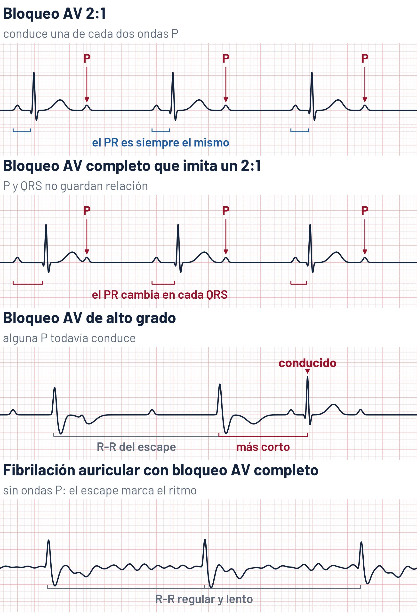 Esquema de cuatro tiras de ECG: en el bloqueo AV 2:1 conduce una de cada dos ondas P y el PR es siempre el mismo; en el bloqueo AV completo que imita un 2:1 hay dos ondas P por cada QRS, pero el PR de la onda P que precede a cada QRS cambia en cada latido; en el bloqueo AV de alto grado, entre escapes de QRS ancho, una onda P conduce con un PR normal y su QRS, estrecho, llega antes de lo que tocaba al siguiente escape; en la fibrilación auricular con bloqueo AV completo no hay ondas P y los QRS anchos son regulares y lentos
