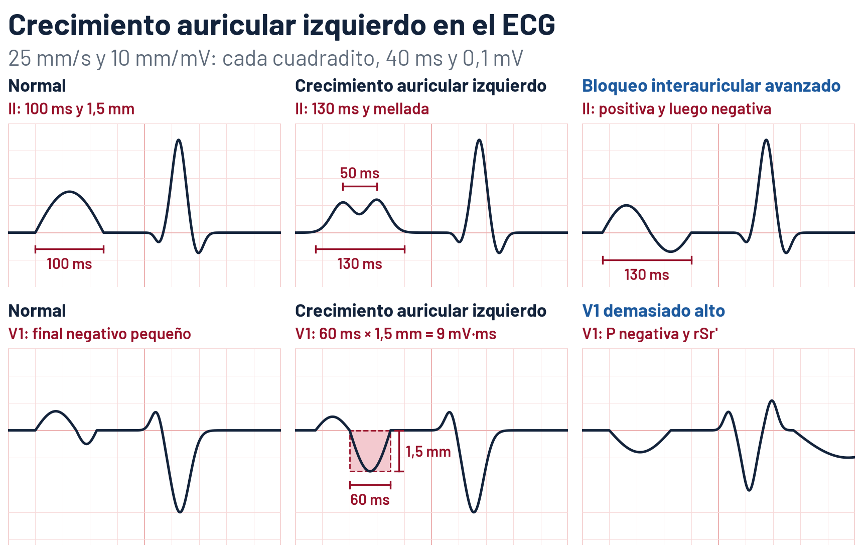 Esquema de seis ondas P a 25 mm/s y 10 mm/mV. En II: P normal de 100 ms y 1,5 mm; P de crecimiento auricular izquierdo de 130 ms, mellada, con 50 ms entre sus dos picos; y P del bloqueo interauricular avanzado, de 130 ms, positiva y luego negativa. En V1: P normal, positiva con un final negativo pequeño; P de crecimiento auricular izquierdo con un final negativo de 60 ms y 1,5 mm, cuyo producto, el índice de Morris, es de 9 mV·ms; y P enteramente negativa seguida de un complejo rSr' por V1 colocado en el segundo espacio intercostal