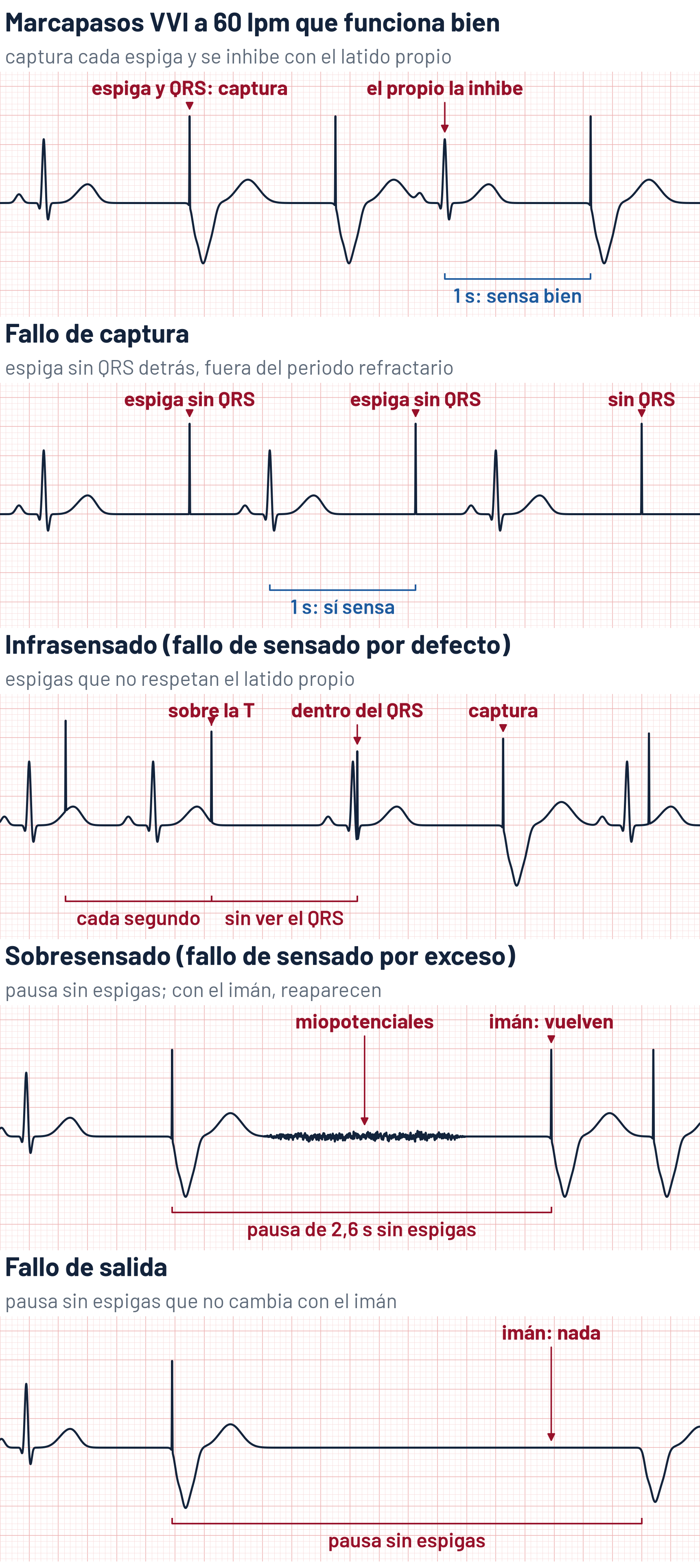 Esquema de cinco tiras de ECG de un marcapasos VVI a 60 lpm, con el QRS estimulado ancho y negativo de la estimulación desde el ápex del ventrículo derecho: en la que funciona bien, cada espiga va seguida de su QRS, un latido propio inhibe la espiga y la siguiente sale 1 segundo después de él; en el fallo de captura, las espigas salen 1 segundo después de cada QRS propio pero no van seguidas de QRS; en el infrasensado, espigas fijas cada segundo caen sobre la onda T y dentro del QRS de los latidos propios y solo capturan cuando el ventrículo está excitable; en el sobresensado, una pausa de 2,6 segundos sin espigas, con ruido de miopotenciales, termina al poner un imán, que devuelve espigas a frecuencia fija que capturan; en el fallo de salida, la pausa sin espigas no cambia con el imán y acaba con un latido de escape ventricular