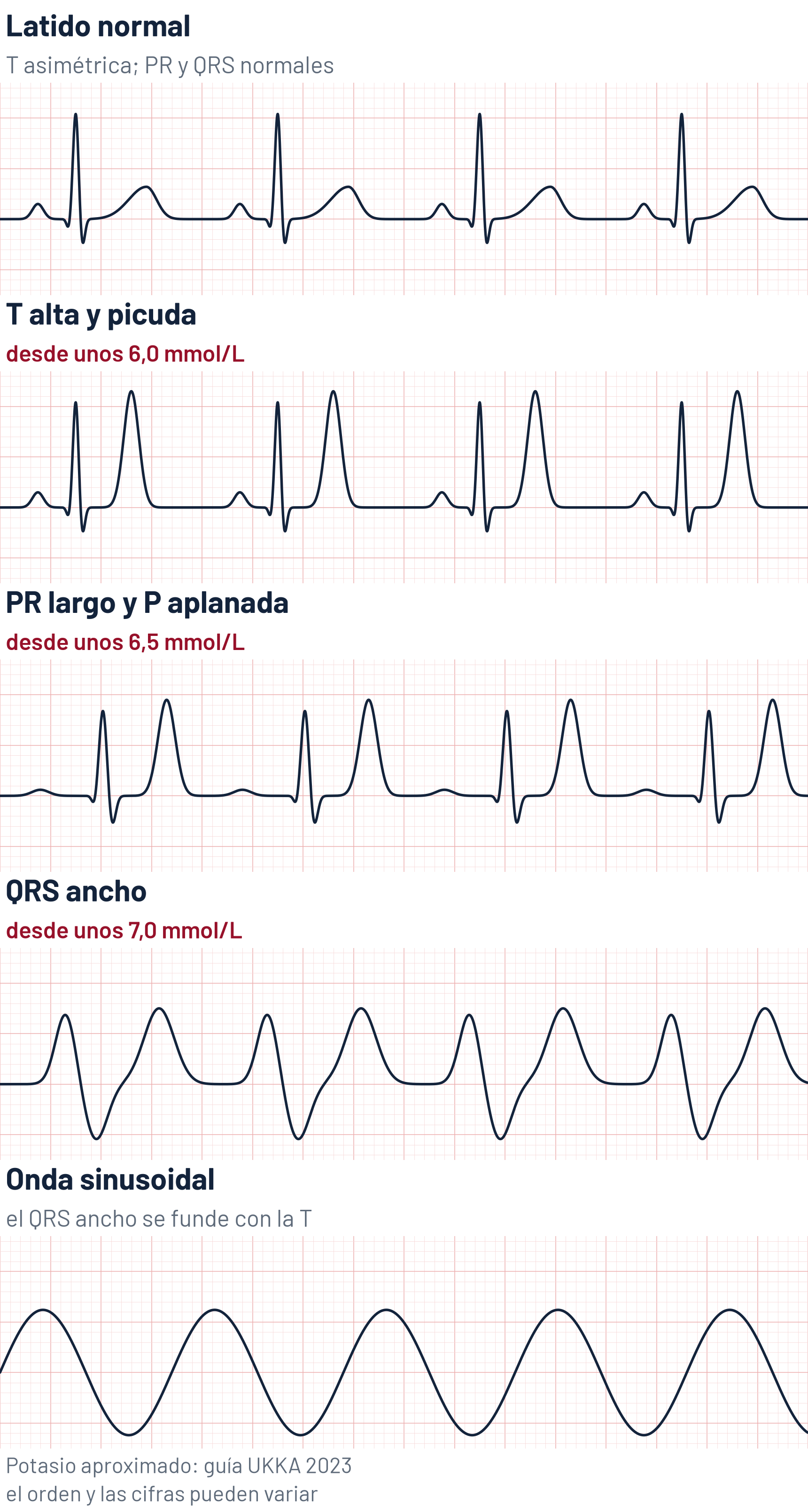 Esquema de la secuencia de cambios del ECG en la hiperpotasemia, en cinco tiras de ECG dibujadas: latido normal con la onda T asimétrica; onda T alta y picuda, desde unos 6,0 mmol/L; PR largo con la onda P aplanada, desde unos 6,5 mmol/L; QRS ancho sin onda P visible, desde unos 7,0 mmol/L; y onda sinusoidal, en la que el QRS ancho se funde con la onda T. Potasio aproximado de la guía UKKA 2023; el orden y las cifras pueden variar