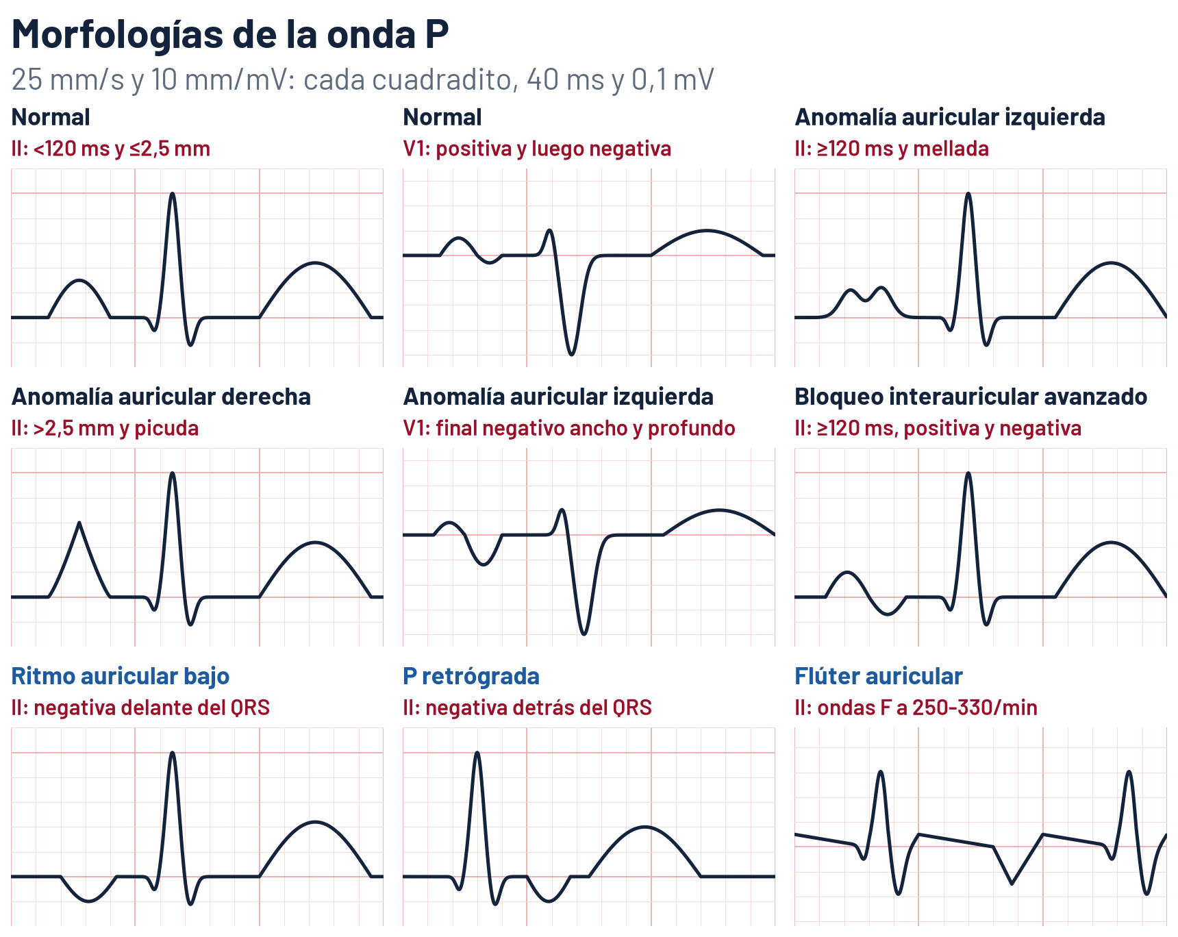 Esquema de nueve morfologías de la onda P a 25 mm/s y 10 mm/mV: P normal en II, de 100 ms y 1,5 mm; P normal en V1, positiva y luego negativa; anomalía auricular izquierda en II, P de 130 ms mellada con 50 ms entre sus dos picos; anomalía auricular izquierda en V1, con un final negativo de 60 ms y 1,2 mm; anomalía auricular derecha en II, P picuda de 3 mm; bloqueo interauricular avanzado en II, P de 130 ms positiva y luego negativa; ritmo auricular bajo, P negativa en II delante del QRS; P retrógrada, negativa en II detrás del QRS; y flúter auricular, ondas F en dientes de sierra negativas en II
