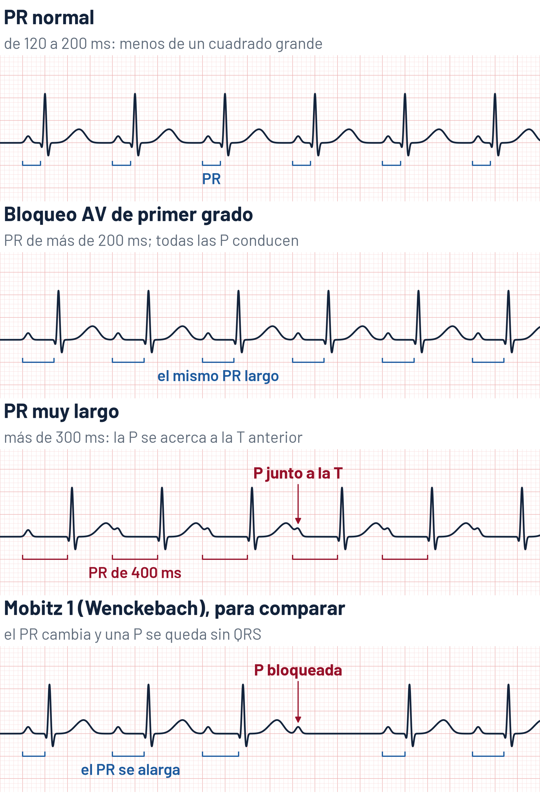 Esquema de cuatro tiras de ECG a 25 mm/s y 75 latidos por minuto. PR normal: el PR, del comienzo de la P al comienzo del QRS, mide 160 ms, menos de un cuadrado grande. Bloqueo AV de primer grado: el PR mide 280 ms, más de un cuadrado grande, igual en todos los latidos, y todas las ondas P van seguidas de su QRS. PR muy largo: el PR mide 400 ms, dos cuadrados grandes, y cada onda P cae al final de la onda T del latido anterior. Mobitz 1 o Wenckebach, para comparar: el PR se alarga de un latido a otro hasta que una onda P se queda sin QRS