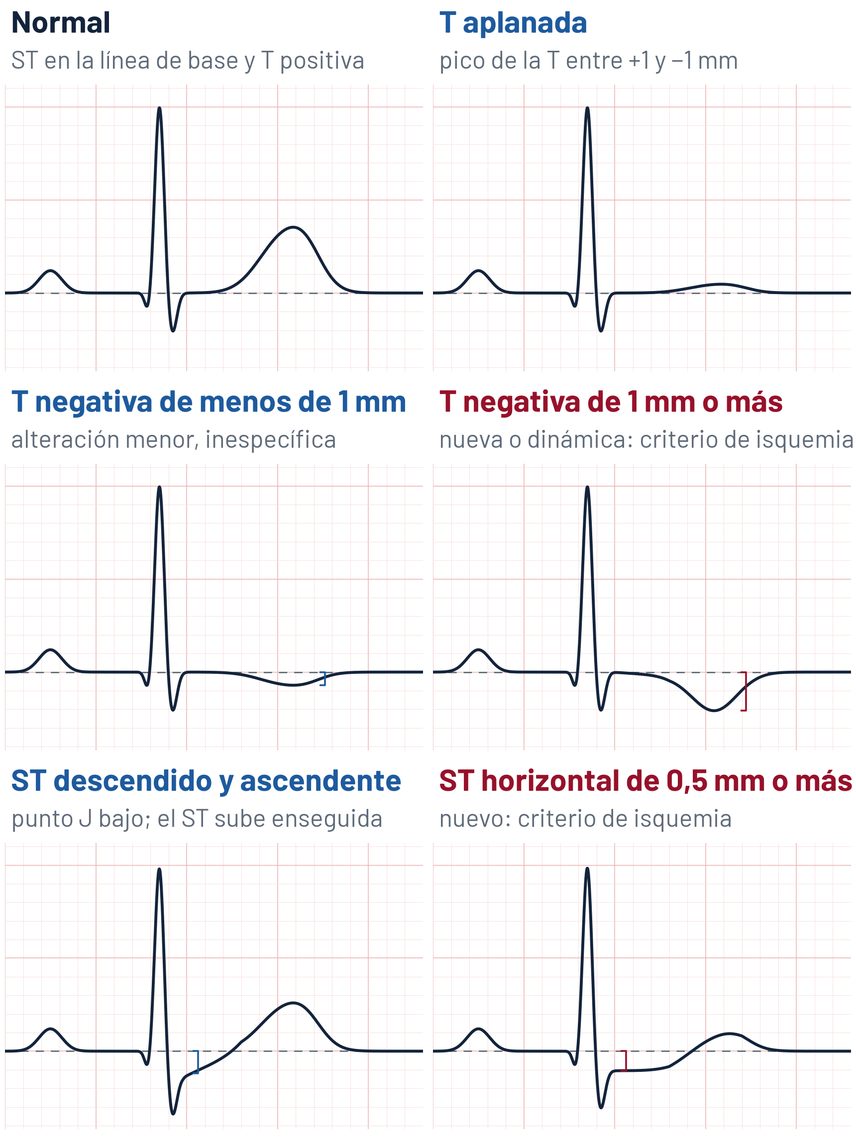 Esquema de seis latidos a 25 mm/s y 10 mm/mV con la línea de base en trazo discontinuo. Izquierda, de arriba abajo: latido normal, con el ST en la línea de base y la T positiva de 3,5 mm; T negativa de 0,7 mm, alteración menor e inespecífica; descenso del ST con el punto J 1,2 mm por debajo de la línea de base y el ST que sube enseguida, inespecífico. Derecha: T aplanada, con el pico a 0,5 mm; T negativa simétrica de 2,1 mm, que si es nueva o dinámica es un criterio de isquemia; descenso horizontal del ST de 1 mm en el punto J, que si es nuevo es un criterio de isquemia